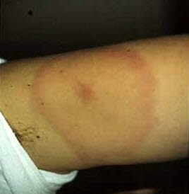 Erythema migrans am Arm