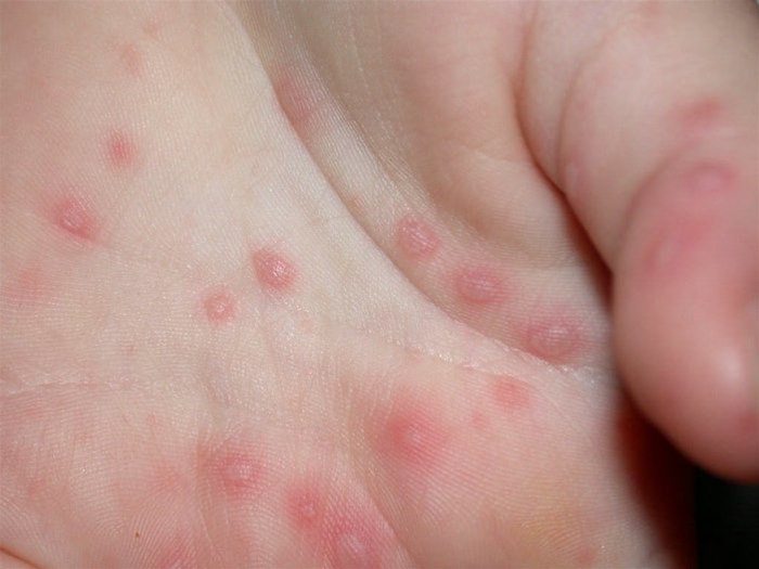 Die Hand-Fuß-Mund-Krankheit ist hochansteckend und kann zu kleineren Epidemien führen. Die Erkrankung kommt vor allem bei Kindern unter 10 Jahren vor. Die Hand-Fuß-Mund-Krankheit ist hochansteckend und kann zu kleineren Epidemien führen. Die Erkrankung kommt vor allem bei Kindern unter 10 Jahren vor.