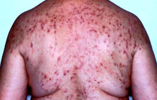 Die Abbildung zeigt eine Dermatitis herpetiformis Duhring mit primären Effloreszenzen in Form von Bläschen oder Vesikeln. Aufgrund von Exkoriation und Erosionen kann dies schwierig zu erkennen sein.