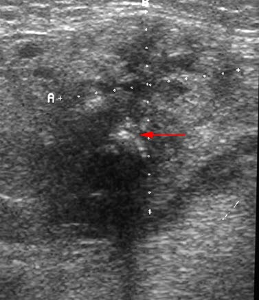 Sialadenitis, Ultraschall