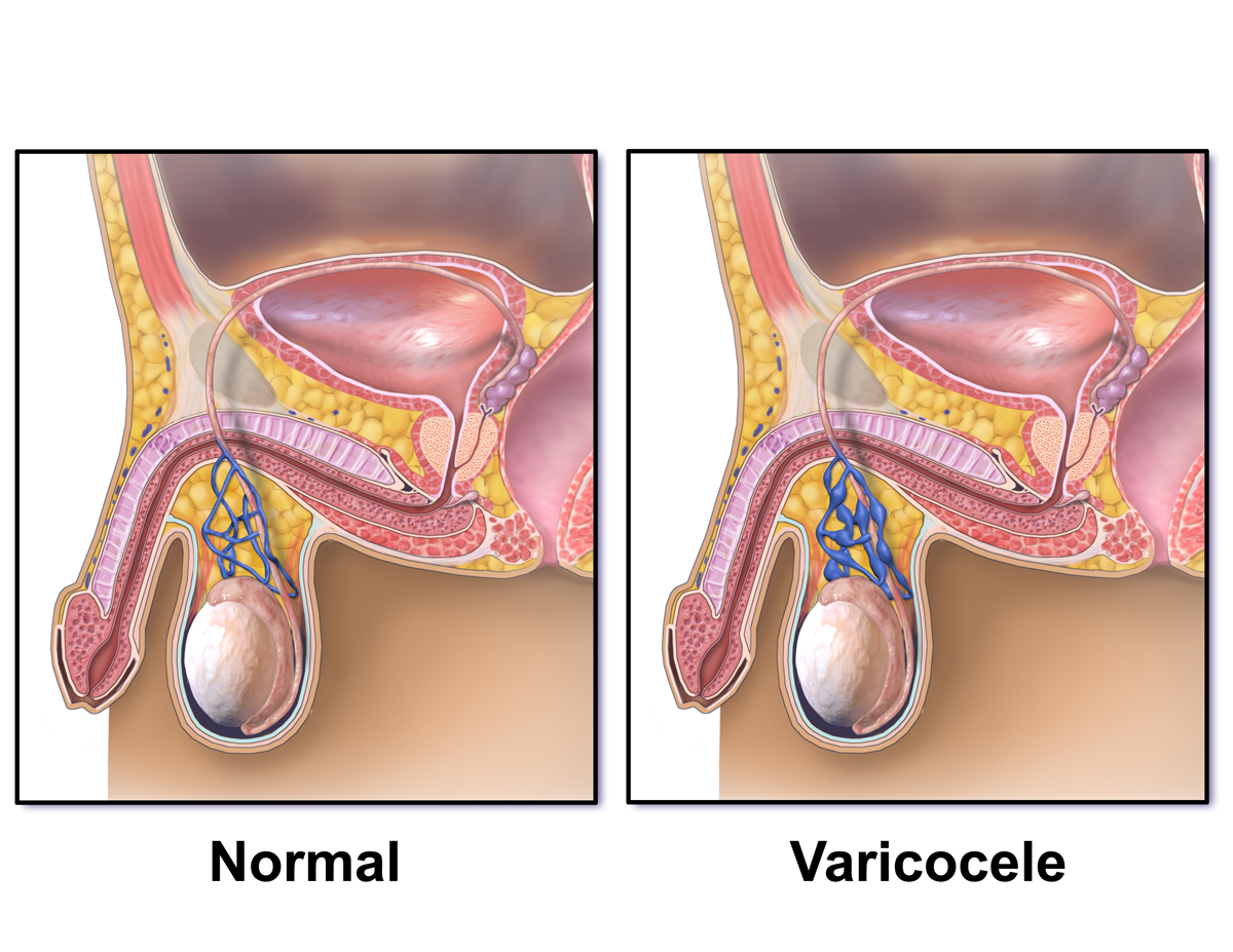 Varicocele.png