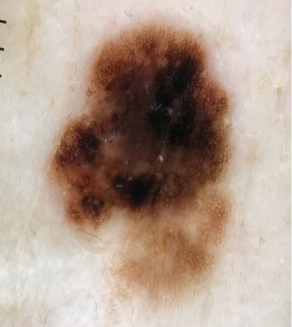 Blotch - Atypisk - Melanom in situ.png